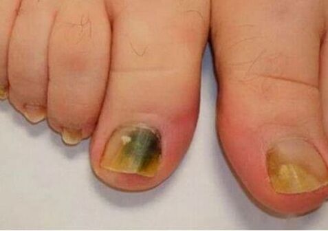 Die Infektion beeinflusst die Nagelplatten