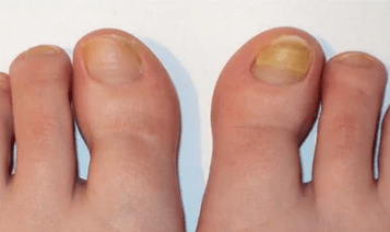 Die Anfangsphase des Nagelpilzes